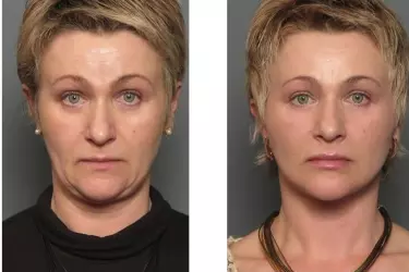 best hospital for facelift surgery in Narsinghpur, best doctor for facelift surgery in Narsinghpur, cost of facelift surgery in Narsinghpur