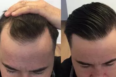 best hospital for hair transplant in Narsinghpur, best doctor for hair transplant in Narsinghpur, cost of hair transplant in Narsinghpur